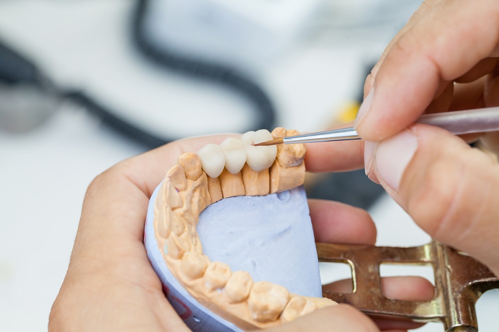 dental bridges for missing teeth
