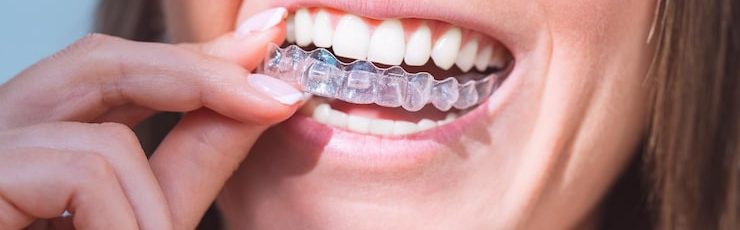 Why invisalign is best for mild to moderate overbite